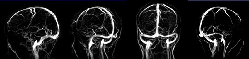 MRV brain MIP images