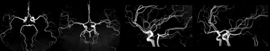 MRA Brain MIP images