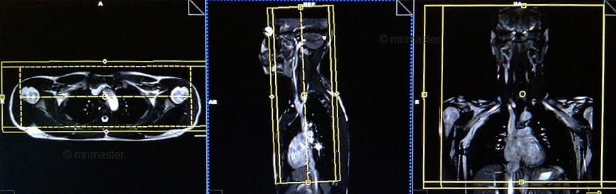 magnetic resonance angiography(MRA) whole body protocols and planning of chest and neck post contrast scans