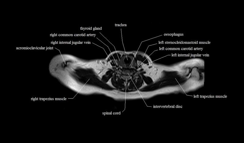 mri cross sectional anatomy chest (thorax) axial