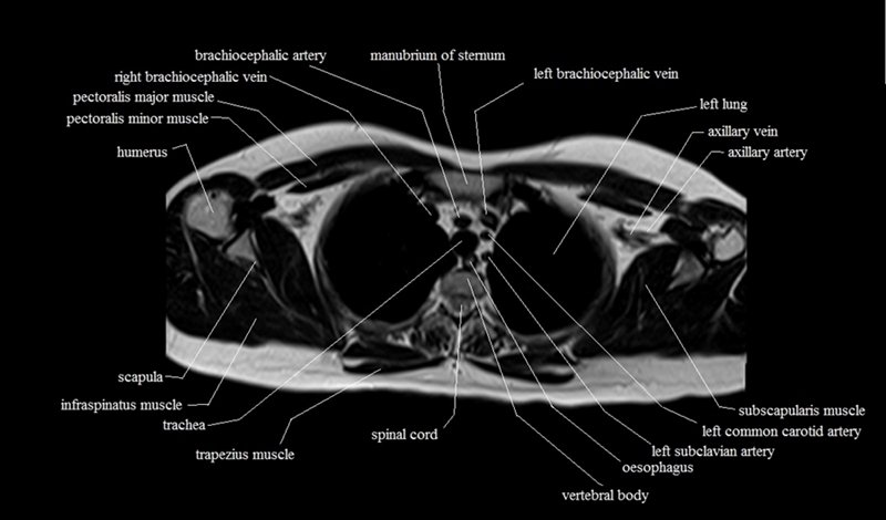 mri cross sectional anatomy chest (thorax) axial