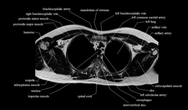 mri cross sectional anatomy chest (thorax) axial
