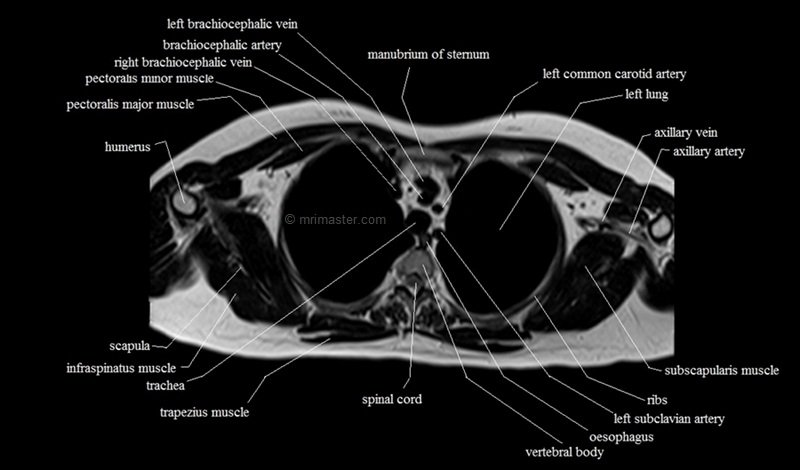 mri cross sectional anatomy chest (thorax) axial