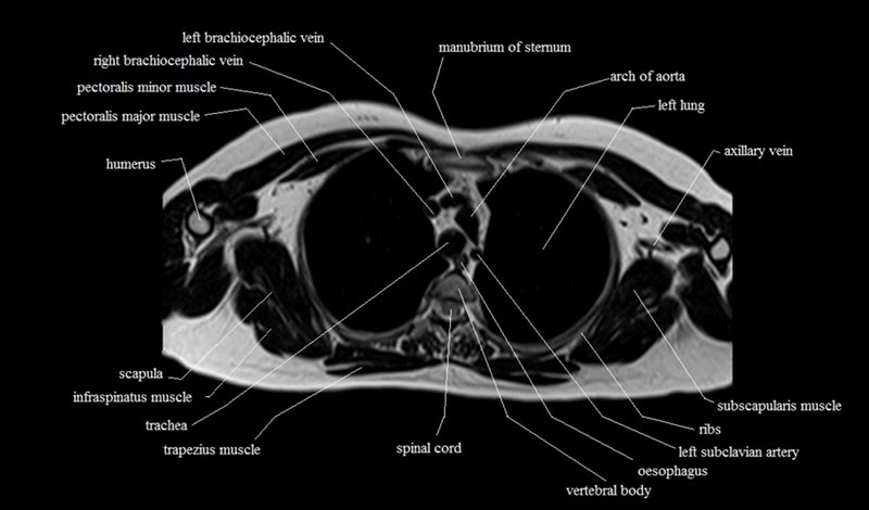 mri cross sectional anatomy chest (thorax) axial