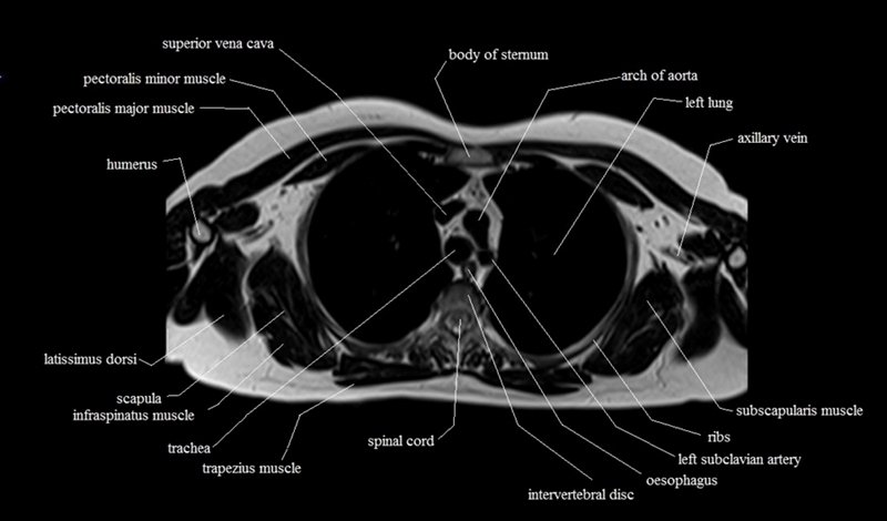 mri cross sectional anatomy chest (thorax) axial