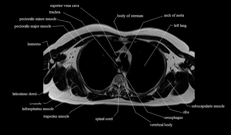 mri cross sectional anatomy chest (thorax) axial