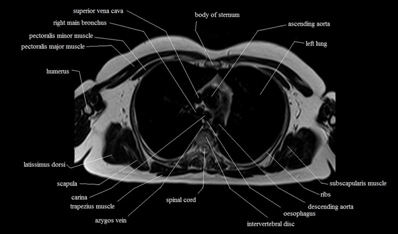mri cross sectional anatomy chest (thorax) axial