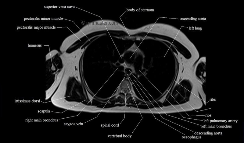 mri cross sectional anatomy chest (thorax) axial