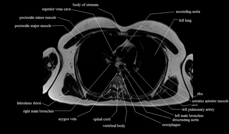 mri cross sectional anatomy chest (thorax) axial