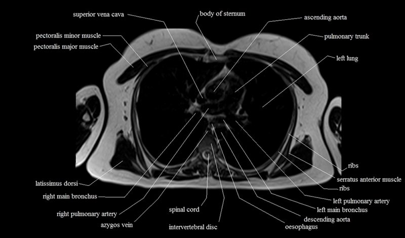 mri cross sectional anatomy chest (thorax) axial