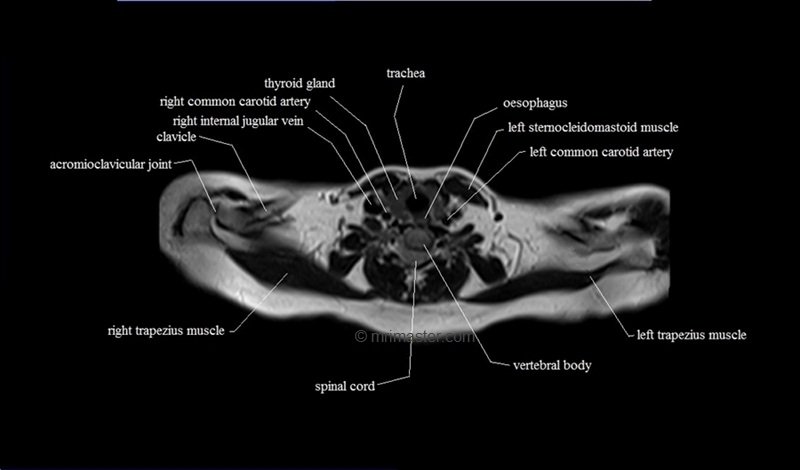 mri cross sectional anatomy chest (thorax) axial