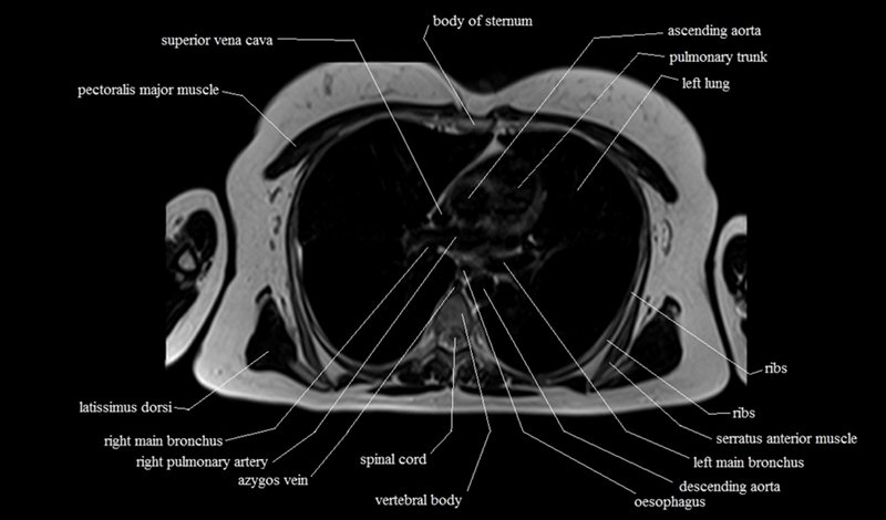 mri cross sectional anatomy chest (thorax) axial