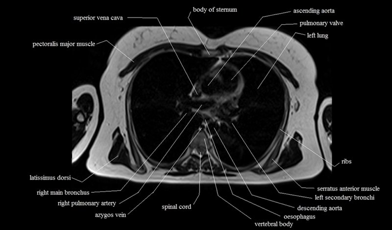 mri cross sectional anatomy chest (thorax) axial