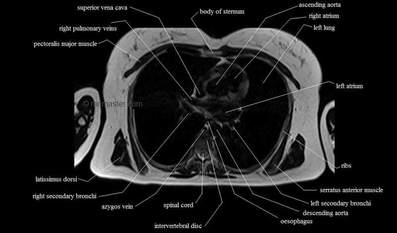 mri cross sectional anatomy chest (thorax) axial