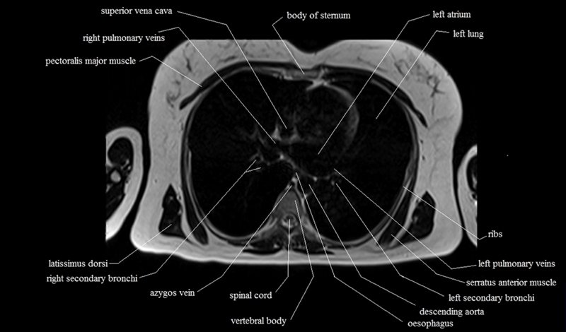 mri cross sectional anatomy chest (thorax) axial