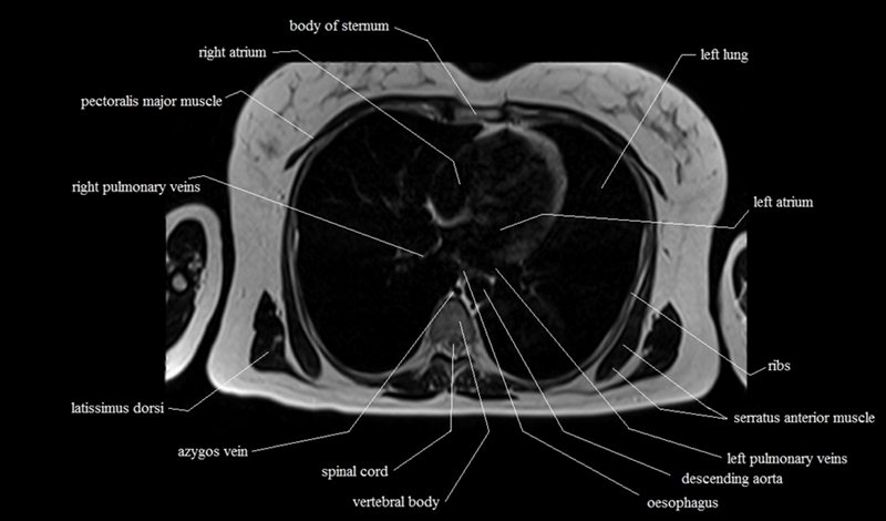 mri cross sectional anatomy chest (thorax) axial
