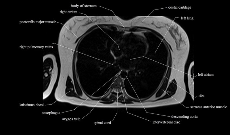 mri cross sectional anatomy chest (thorax) axial