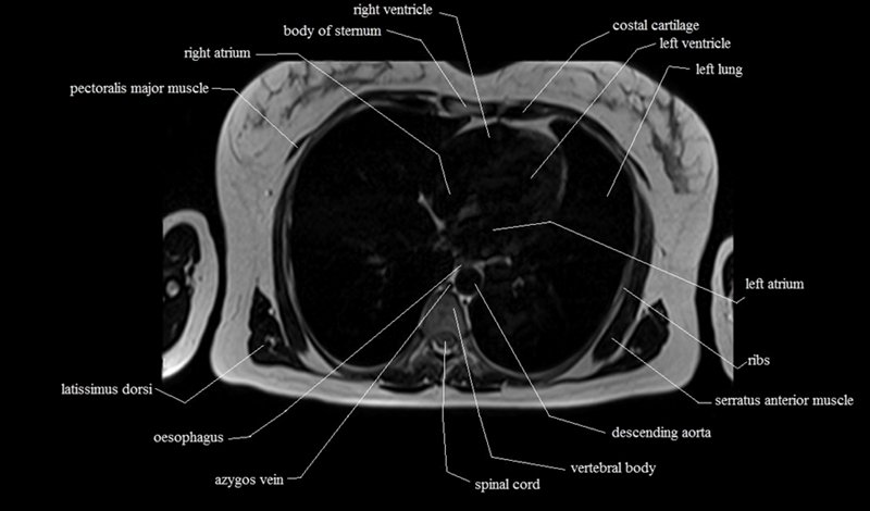 mri cross sectional anatomy chest (thorax) axial