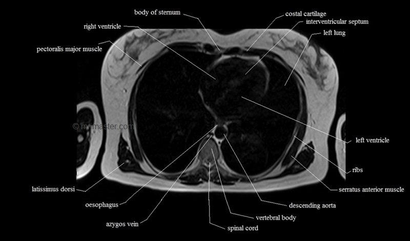 mri cross sectional anatomy chest (thorax) axial