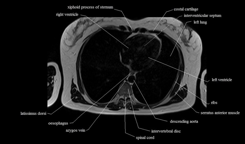 mri cross sectional anatomy chest (thorax) axial
