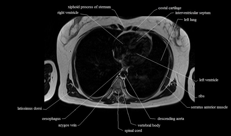 mri cross sectional anatomy chest (thorax) axial