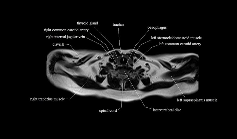 mri cross sectional anatomy chest (thorax) axial