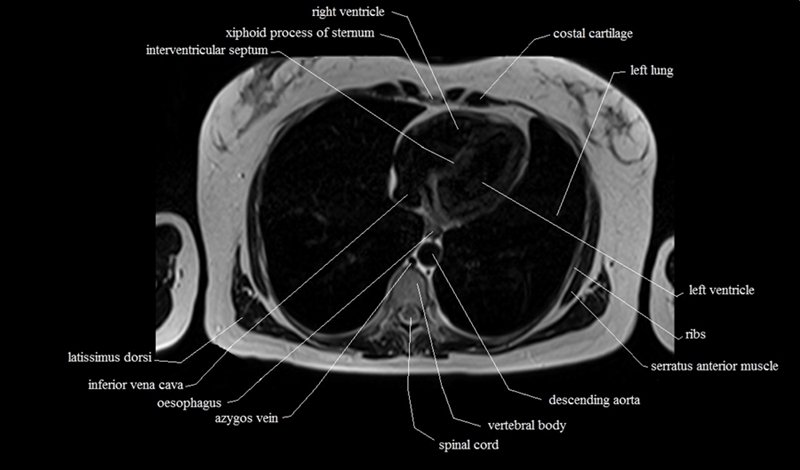 mri cross sectional anatomy chest (thorax) axial