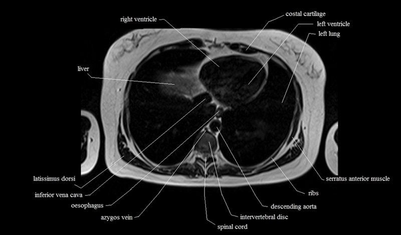 mri cross sectional anatomy chest (thorax) axial