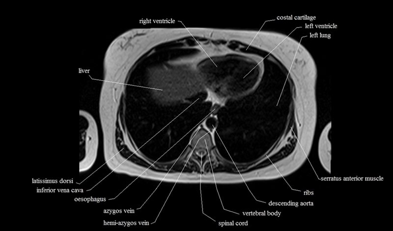 mri cross sectional anatomy chest (thorax) axial