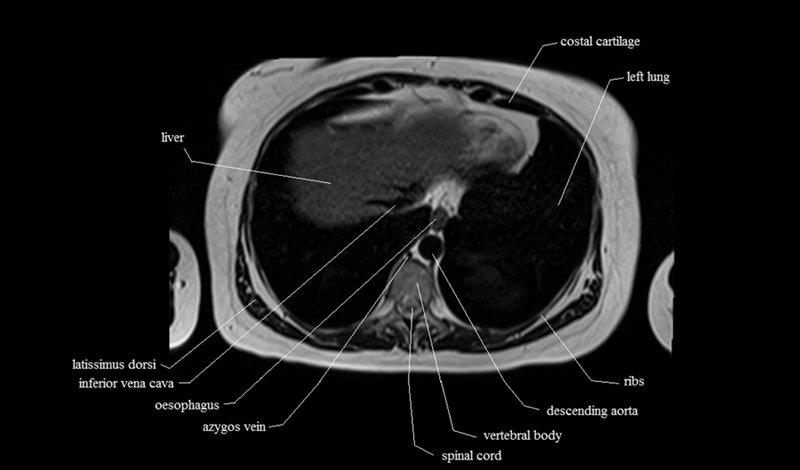 mri cross sectional anatomy chest (thorax) axial