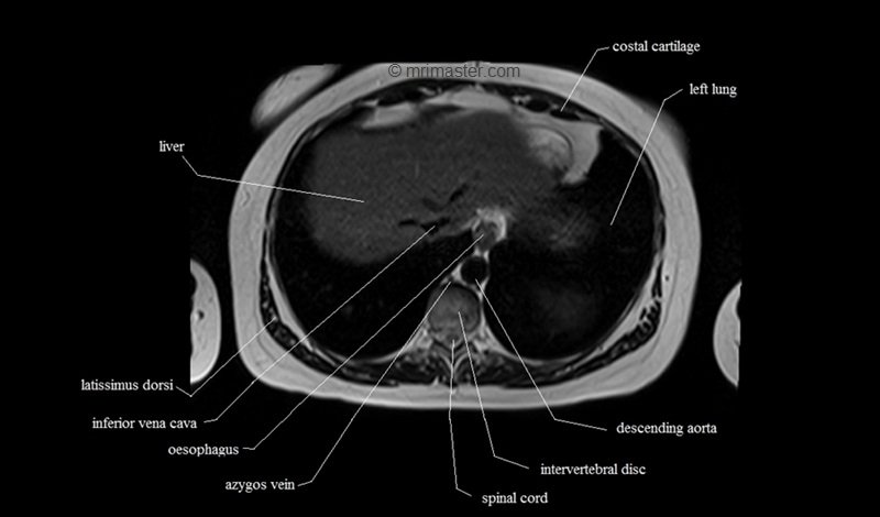 mri cross sectional anatomy chest (thorax) axial