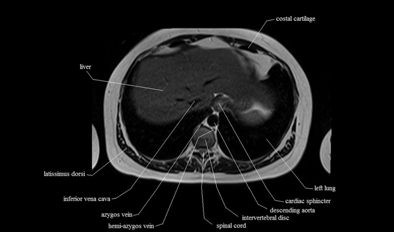 mri cross sectional anatomy chest (thorax) axial