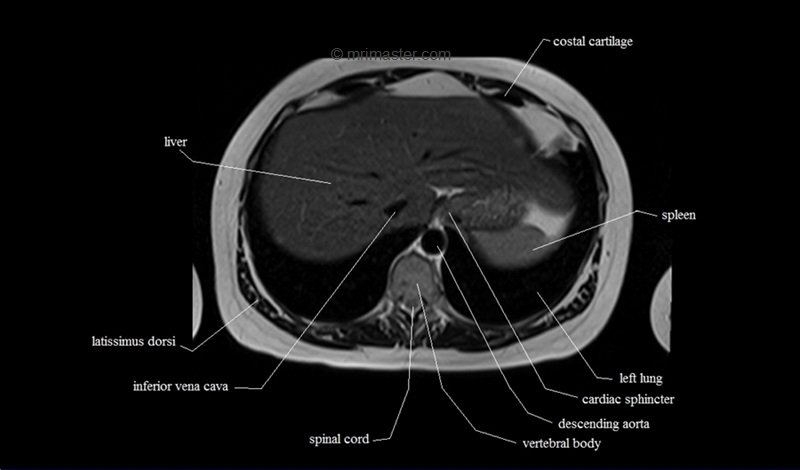 mri cross sectional anatomy chest (thorax) axial