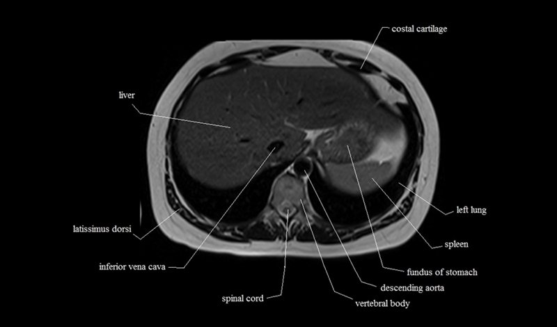 mri cross sectional anatomy chest (thorax) axial