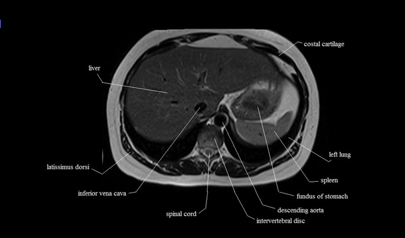 mri cross sectional anatomy chest (thorax) axial