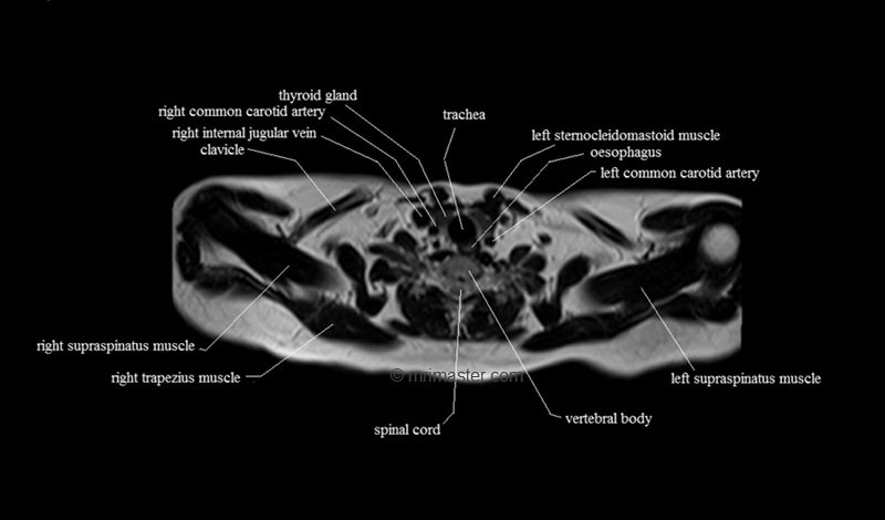 mri cross sectional anatomy chest (thorax) axial
