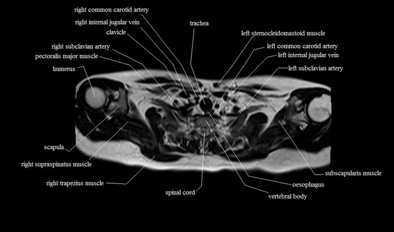 mri cross sectional anatomy chest (thorax) axial