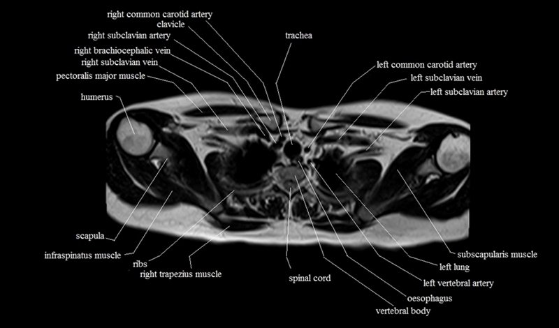 mri cross sectional anatomy chest (thorax) axial