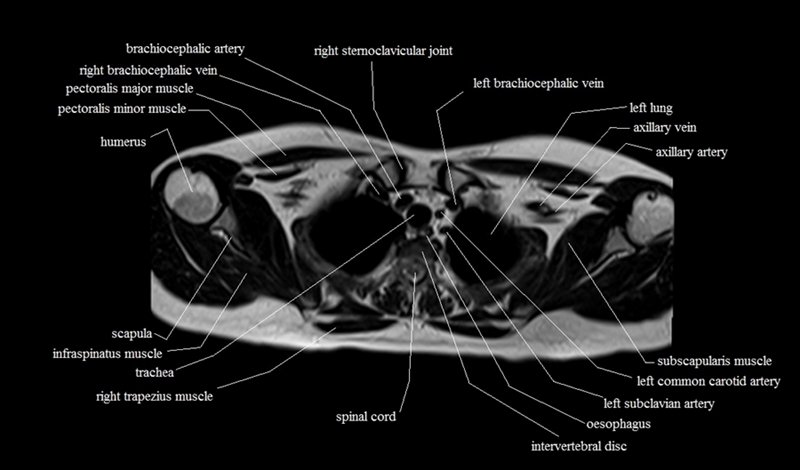 mri cross sectional anatomy chest (thorax) axial