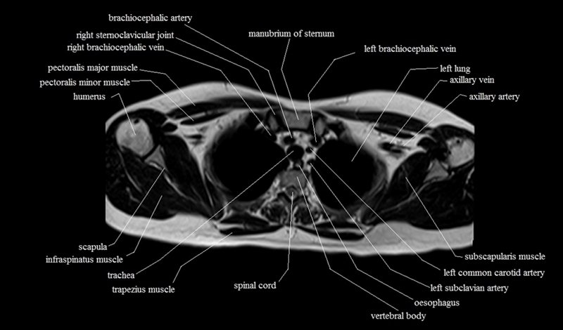 mri cross sectional anatomy chest (thorax) axial