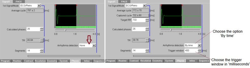 Arrhythmia correction cardiac MRI