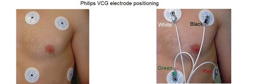 Philips VCG electrode positioning mri