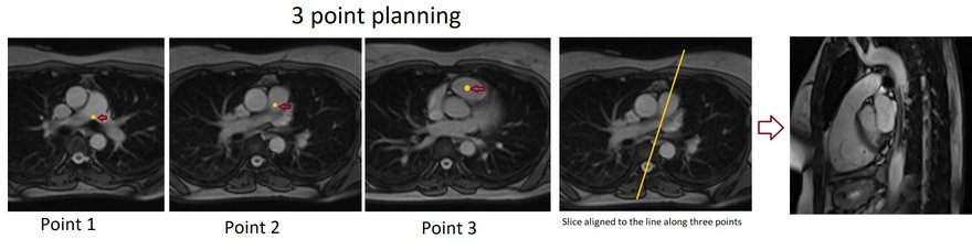 Right ventricular outflow tract (RVOT) 3 point cardiac MRI planning image