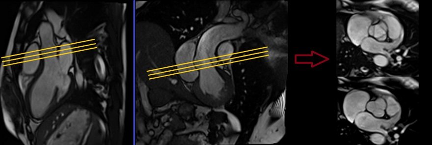 aortic valve cardiac mri planning