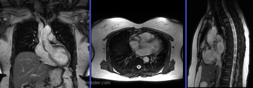 cardiac mri localiser