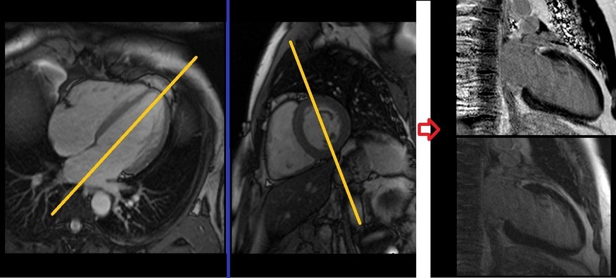 cardiac mri planning psir 2ch