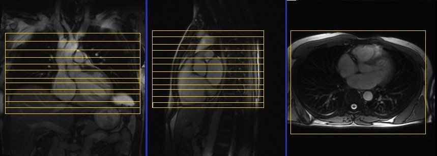 cardiac mri protocols and planning of axial dark blood
