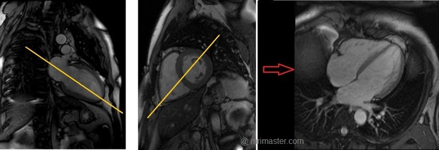 cardiac mri protocols and planning of four chamber localizer