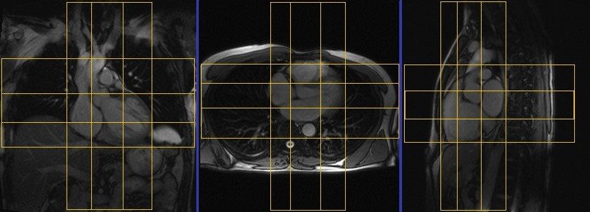 cardiac mri protocols and planning of localizer