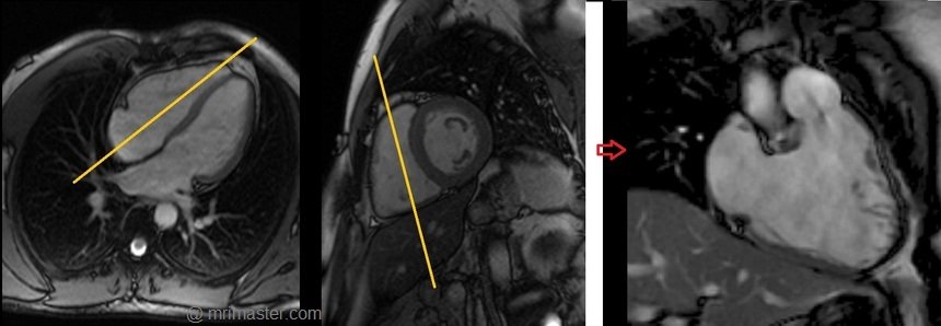 cardiac mri protocols and planning of right two chamber cine
